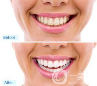 洗牙后具體注意事項有哪些