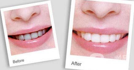 洗牙后具體注意事項有哪些