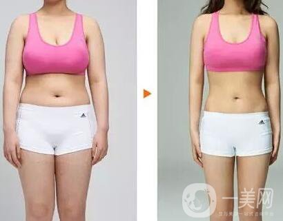 鐳射溶脂價格要多少錢？