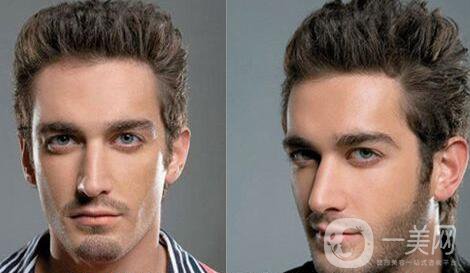 植鬢角價(jià)格要多少錢