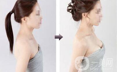 妙桃假體豐胸,價(jià)格