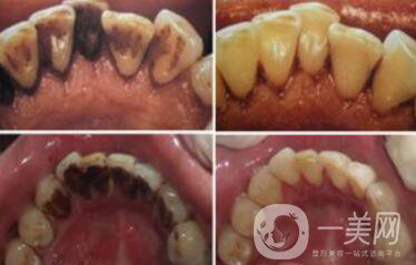 *潔牙好不好？*果可以維持幾年？