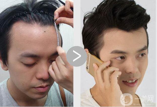 fue植發(fā)技術(shù),*果