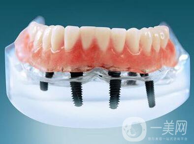 種植牙可以用多久？維持時間