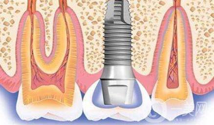 種植牙可以用多久？維持時間