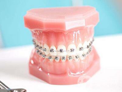 t4a牙齒矯正器佩戴方法