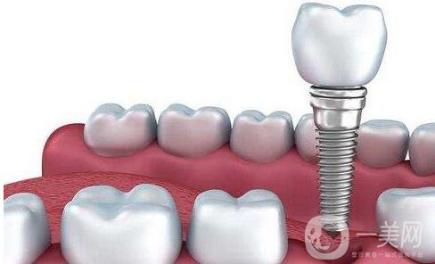 北京,種植牙,多少錢