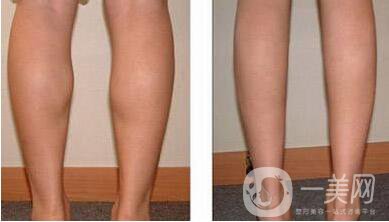 射頻溶脂,瘦小腿,*果,保持多久