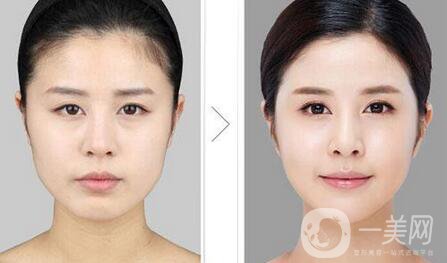 國內(nèi)醫(yī)院做磨下頜角手術(shù)項(xiàng)目的價(jià)格介紹一覽