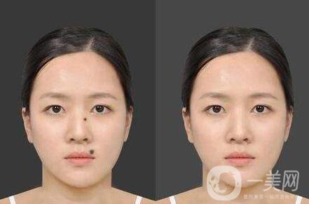 激光點痦子,多少錢