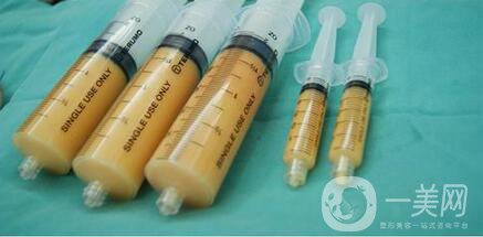 自體脂肪豐眼窩手術(shù)恢復(fù)過(guò)程介紹 術(shù)后注意一覽