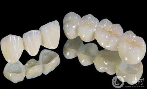 鈷鉻烤瓷牙好不好？可以保持多久？