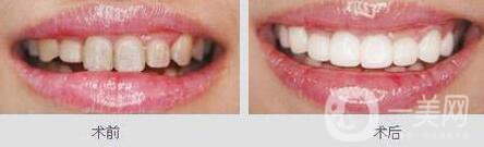 鈷鉻烤瓷牙好不好？可以保持多久？