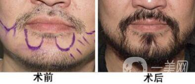 廣州種植胡須手術(shù)需要多少錢