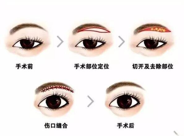 上海眉整形大概需要多少錢？