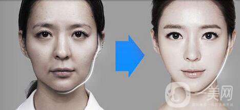 *針瘦臉多少錢(qián) 明星都推薦的瘦臉秘籍
