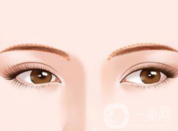 北京假體豐眉弓具體需要多少錢