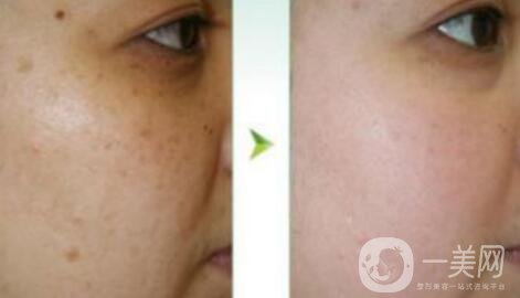 在正規(guī)醫(yī)院做飛頓彩光嫩膚*果好嗎