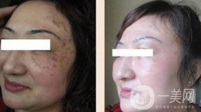 在正規(guī)醫(yī)院做飛頓彩光嫩膚*果好嗎