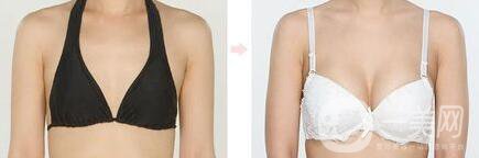 美國麥格假體隆胸怎么樣？麥格假體多少錢？
