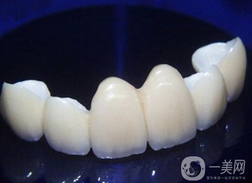 貴金屬烤瓷牙和全瓷牙信息介紹？