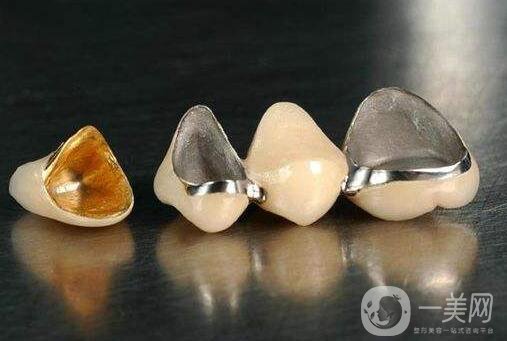 貴金屬烤瓷牙和全瓷牙信息介紹？