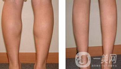 *瘦小腿反彈嗎？