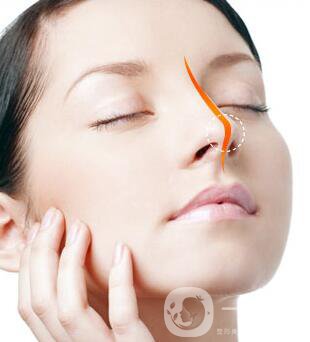 硅膠墊鼻梁多久生包膜？如何避免隆鼻后遺癥？