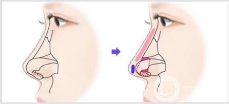 朝天鼻矯正*果是*的嗎 怎么才能擁有明星翹鼻