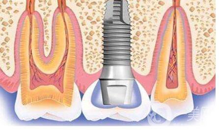 種植牙,術后注意事項