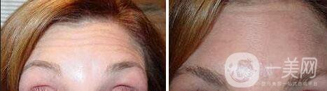 抬頭紋太深怎么辦?消除抬頭紋的好方法介紹