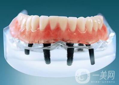 上海九院種植牙價格要多少錢？