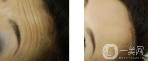 激光去抬頭紋怎么樣、*果*嗎