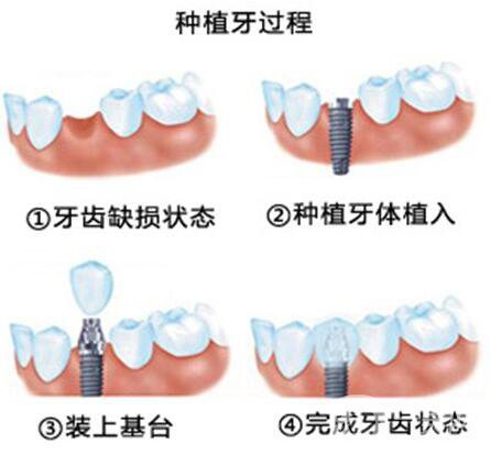 鄭州,種植牙,價格