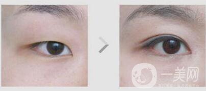 不開刀的雙眼皮*果是*的嗎