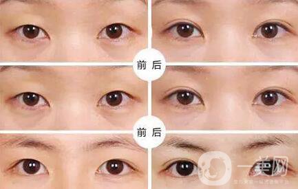 不開刀的雙眼皮*果是*的嗎