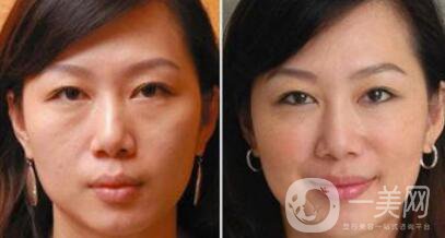 塑美極*果怎么樣？塑美極要做多少次？