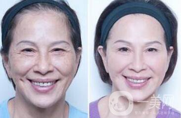 塑美極*果怎么樣？塑美極要做多少次？