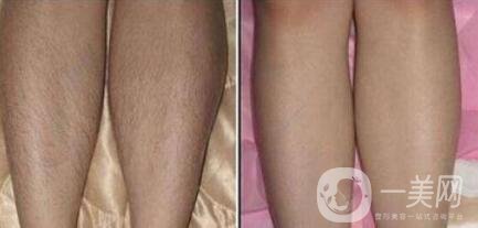 怎么去腿毛？*脫腿毛的方式是什么？