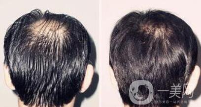 蛋白纖維植發(fā)好不好？植發(fā)解決頭發(fā)稀疏的問(wèn)題