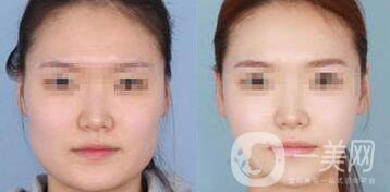 怎樣變瓜子臉？磨骨整形還是*？