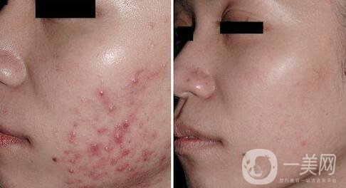 果酸換膚*嗎？果酸換膚要做幾個(gè)療程？