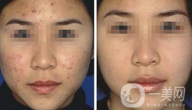 果酸換膚*嗎？果酸換膚要做幾個(gè)療程？