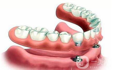 昆山,種植牙,多少錢