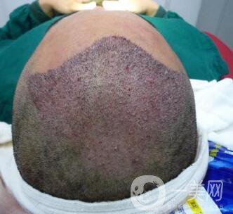 北京醫(yī)院做人工頭發(fā)種植價格 發(fā)際線后移也不是問題 