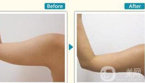 上臂吸脂減肥術(shù),多少錢