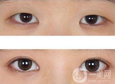 開眼角如何防止增生 開眼角輕松放大雙眼