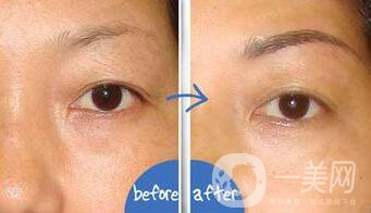 提切眉*果怎么樣？提切眉手術(shù)后注意事項(xiàng)