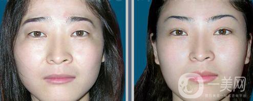 提切眉*果怎么樣？提切眉手術(shù)后注意事項(xiàng)