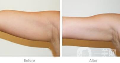 吸脂瘦手臂*果怎么樣？輕松擁有纖細(xì)手臂